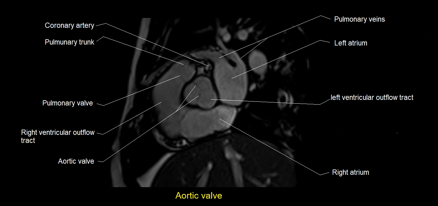 Aortic valve.webp